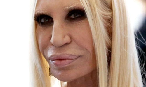 Khuôn mặt biến đổi kinh hoàng sau 20 năm lạm dụng botox