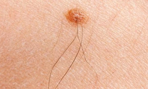 Biến chứng nguy hiểm do tự tẩy nốt ruồi