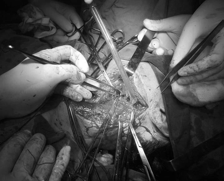 Hy hữu bệnh nhân bị đâm thấu ngực, sát tim được cứu sống