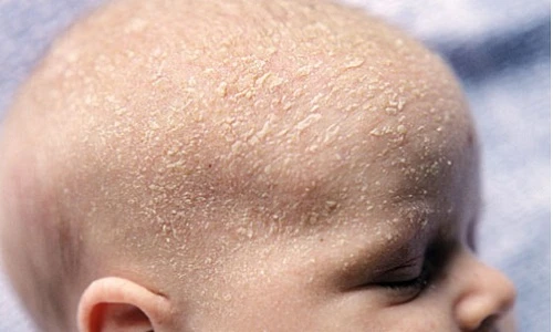 7 mẹo đơn giản trị “cứt trâu” cho bé