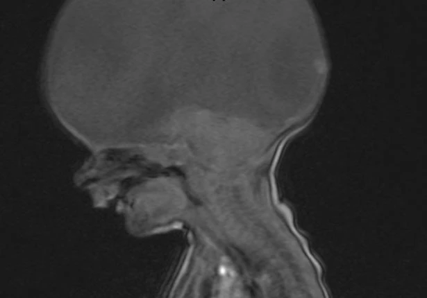 Sốc nặng em bé không có não vẫn sống khỏe, biết gọi mẹ