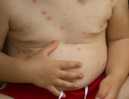 Cách đơn giản nhận biết bé bị thủy đậu
