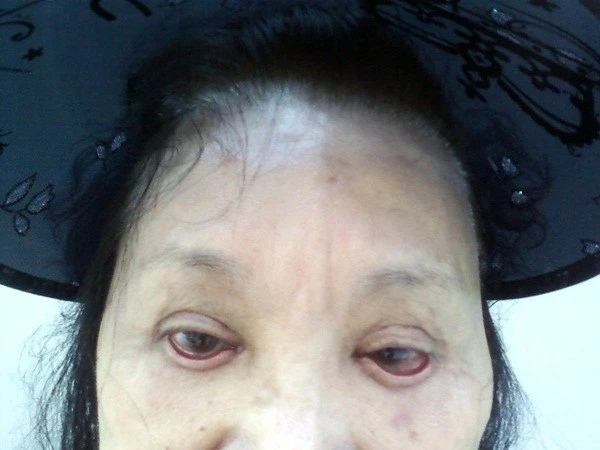 Mù mắt, biến dạng sau phẫu thuật cắt mí mắt