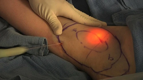 8 phương pháp dao kéo mới dễ gây di chứng