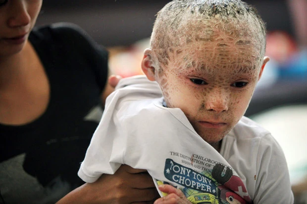 Hình ảnh đáng thương của em bé “người cá”