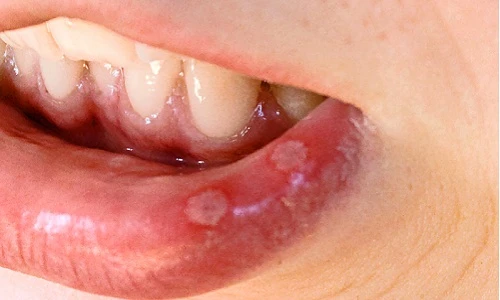 Mẹo hay chữa nhiệt miệng khi bị nóng trong