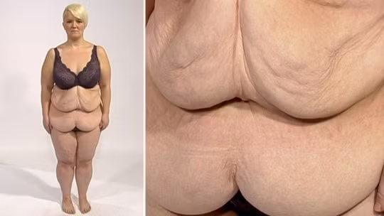 Kinh hoàng những bộ da thừa do giảm béo