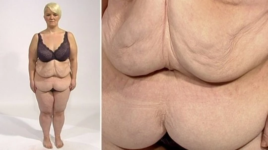 Kinh hoàng những bộ da thừa do giảm béo