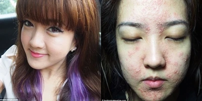 Kinh hãi nổi mụn chi chít, lột da vì tắm trắng