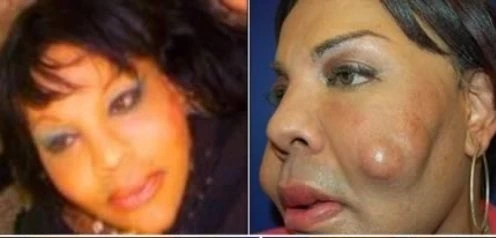 Hình ảnh nổi da gà những cơ thể biến dạng vì dao kéo