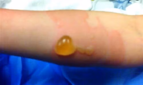 Sai lầm “chết người” khi chữa bỏng bô xe máy