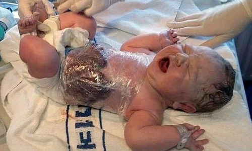 Cậu bé sống sót dù ruột và bàng quang ngoài cơ thể