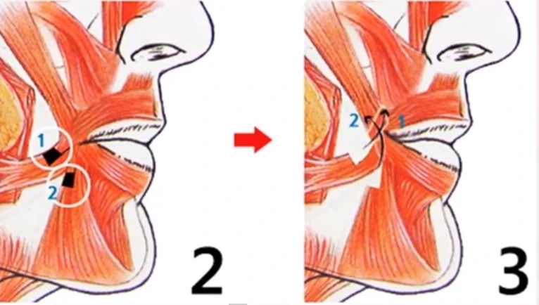 Tận mục quy trình cắt miệng xinh như "hot girl" Hàn