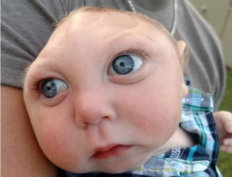 Kỳ dị em bé không có hộp sọ vẫn sống khỏe mạnh