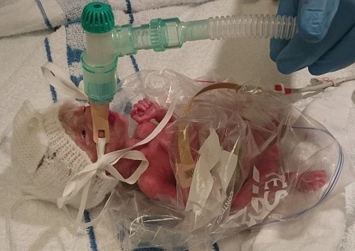 Ngắm em bé sinh non 0,5kg sống sót nhờ túi đựng bánh