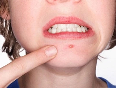 Cách trị mụn bọc có mủ tại nhà hiệu quả nhất