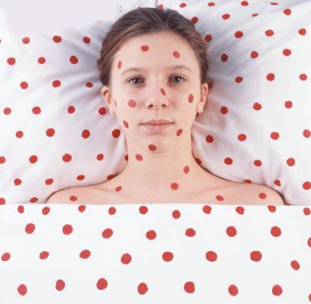 Sốt phát ban Rubella: Đây là bệnh lây qua đường hô hấp, đang lưu hành trong toàn quốc. Lứa tuổi thường gặp là thanh thiếu niên. Sau thời gian ủ bệnh 1-2 tuần, bệnh nhân sốt nhẹ 1-2 ngày rồi phát ban đỏ khắp mặt, cổ, chân tay. Các triệu chứng hay gặp khác là nổi hạch ở hai bên cổ, mắt đỏ, ho khan. Người bệnh mệt nhọc không thể học tập, làm việc trong 3-5 ngày. Một số biến chứng có thể gặp là viêm não, xuất huyết giảm tiểu cầu, viêm khớp...
