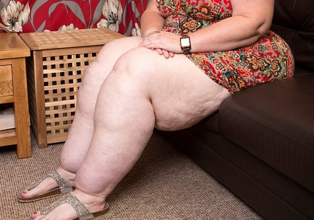 Hoảng hồn người phụ nữ có đôi chân nặng hơn nửa tạ