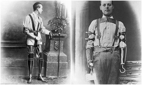 Xem ảnh thật những bộ chân tay giả từ thế kỷ 19