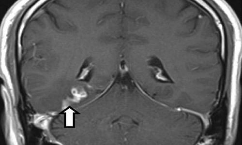 Kinh hoàng sán 5 cm ký sinh trong não người 4 năm