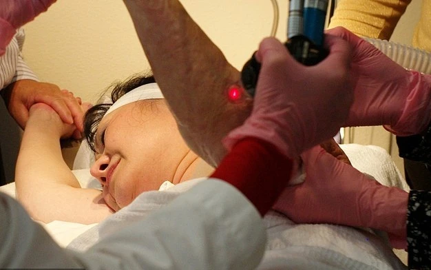 Chi tiết quy trình trị sẹo bỏng bằng laser cho “em bé Napalm“