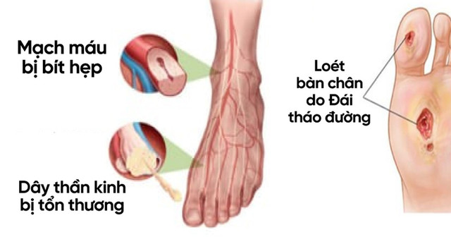 Loét bàn chân nặng vì 'buông bỏ' điều trị đái tháo đường - Hình 2 Loet ban chan nang vi 'buong bo' dieu tri dai thao duong-Hinh-2