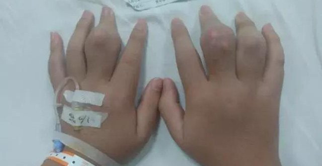 Uống trà sữa 2 ngày một cốc, thanh niên 18 tuổi nổi u ở tay chân - Hình 2 Uong tra sua 2 ngay mot coc, thanh nien 18 tuoi noi u o tay chan-Hinh-2