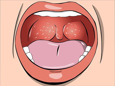 2. Ung thư vòm họng. Ung thư phát sinh trong khu vực vòm họng, trong đó lỗ mũi và các ống eustachian kết nối với phần trên của cổ họng.
