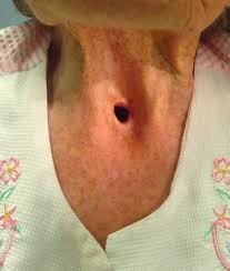 Phẫu thuật có thể bao gồm laryngectomy một phần (loại bỏ một phần của thanh quản) và laryngectomy tổng số (toàn bộ thanh quản). Nếu được gỡ bỏ toàn bộ thanh quản vĩnh viễn người ta có thể học cách nói chuyện theo cách mới với sự giúp đỡ của giảng dạy chuyên sâu, ngôn ngữ trị liệu và / hoặc một thiết bị điện tử.