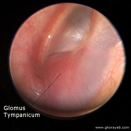 2. Khối u glomus phát sinh từ cấu trúc đặc biệt phía sau màng nhĩ, và được giới hạn trong tai (glomus tympanicum) hoặc có thể lây lan vào cổ (glomus jugulare). Mặc dù lành tính và phát triển chậm, khối u glomus có thể phá hủy các chức năng quan trọng của tai, làm tê liệt mặt, và thậm chí lan đến não nếu không được điều trị.