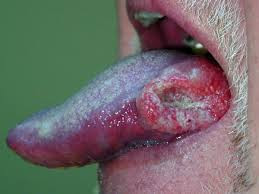 8. Vi rút HPV có thể gây ung thư lưỡi. Các cơ sở của lưỡi bị nhiễm trùng trong trường hợp này. Vật liệu di truyền của vi rút HPV tự sao chép, lây lan ung thư đến các bộ phận khác của miệng (hầu họng) với tốc độ ngẫu nhiên.