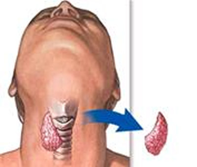 Các khối u nang trứng có thể chữa được, nếu chúng không bị nhiễm các mạch máu và cấu trúc liền kề cổ.
