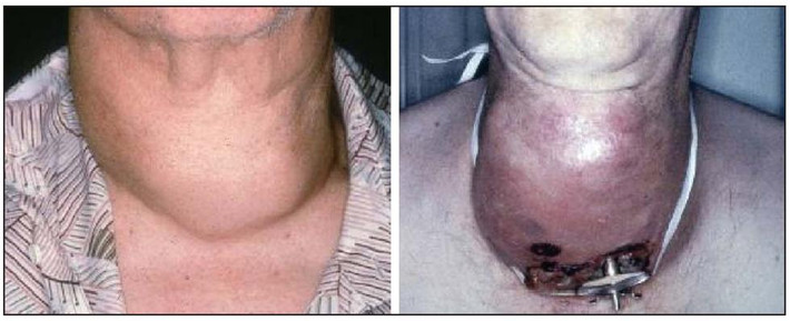 4. Ung thư biệt hóa: khối u tuyến giáp biệt hoá phát triển nhanh nhất trong số tất cả các khối u. Đây là loại ung thư có tiên lượng xấu, với tỷ lệ sống 5 năm chỉ khoảng 14%. Ung thư biệt hoá rất ác tính, và nó thường không đáp ứng với các phương pháp điều trị ung thư.