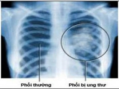 Một nửa trong số họ có 3 lần chụp CT liều thấp hàng năm - một loại tia X nhạy hơn bình thường - và một nửa có ba lần chụp X-quang. 1.089 bệnh ung thư phổi được chẩn đoán ở bệnh nhân chụp CT, so với 969 đối với những người đã chụp X-quang.