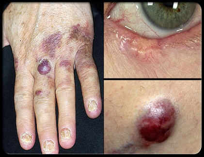 Sarcoma Kaposi là loại ung thư da phổ biến ở người có hệ miễn dịch suy yếu, thường được thấy ở đầu, cổ, cánh tay và chân nhưng lan truyền đến các bộ phận khác của cơ thể; và ung thư biểu mô tuyến bã nhờn, một dạng ung thư bắt nguồn từ các tuyến dầu trên da.