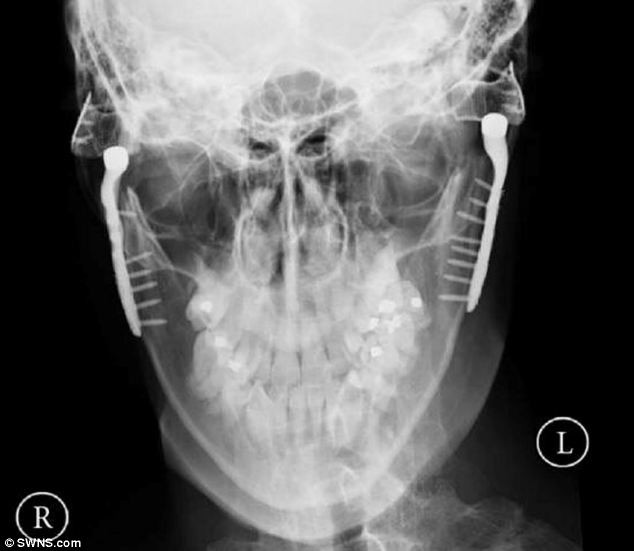 Ông Sidebottom, người có 12 năm kinh nghiệm tư vấn tại bộ phận hàm mặt Trung tâm y tế Nottingham, đã quét 3D hàm, hộp sọ bà Clarke và gửi chúng đến một công ty Mỹ. Công ty đã thiết kế riêng biệt xương hàm được làm từ titan và nhựa cao phân tử để cấy ghép cho bà.