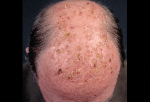 Hội chứng dermatoheliosis (dày sừng) thường có vảy khô, rát, sẩn và thô, màu vàng-xám gây ra sốt xuất huyết; dễ bị tổn thương chỉ với một móng tay, thường gây ra đau đớn.