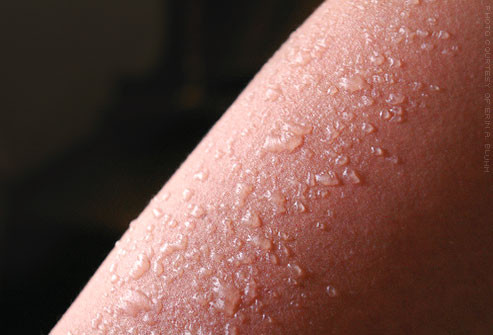 Cháy nắng mức độ 2.