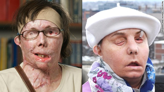 Gương mặt Carmen Blandin Tarleton biến dạng khi bị chồng cũ tạt dung dịch kiềm công nghiệp. Sau phẫu thuật, cô cho biết mình cảm thấy hồi hộp và mong chờ được hôn bạn trai.