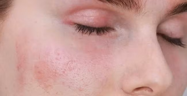 Chà xát da bằng bột đậu gà, đá vôi hay hỗn hợp tự chế dễ làm tổn thương lớp bảo vệ da, thậm chí gây bỏng rát, khiến nám nặng hơn. Thay vào đó, hãy chọn sản phẩm chứa vitamin C, axit azelaic hoặc niacinamide – những thành phần đã được chứng minh an toàn. Ảnh minh họa