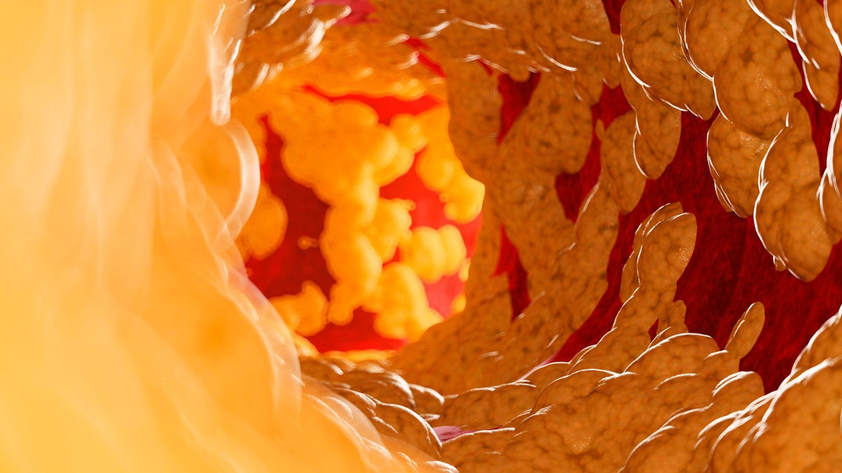 Mỡ nội tạng là loại mỡ nằm sâu trong khoang bụng, bao quanh gan, ruột, tụy và nhiều cơ quan quan trọng khác. Khác với mỡ dưới da, mỡ nội tạng khó nhận biết nhưng lại liên quan mật thiết đến nguy cơ tiểu đường type 2, bệnh tim mạch và rối loạn chuyển hóa, kể cả ở những người có cân nặng bình thường. Ảnh minh họa