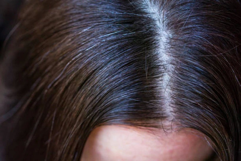 Bên cạnh yếu tố di truyền, chuyên gia cho rằng việc bổ sung thực phẩm giàu vitamin, khoáng chất và chất chống ôxy hóa là cách tự nhiên để bảo vệ tế bào sắc tố tóc và duy trì mái tóc khỏe mạnh. Ảnh minh họa