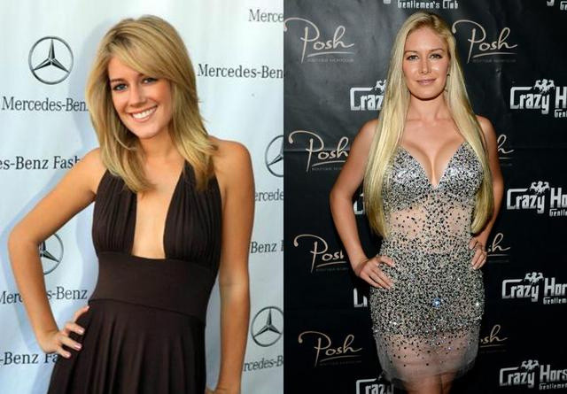 Ngôi sao truyền hình thực tế Heidi Montag nổi tiếng với 10 cuộc phẫu thuật thẩm mỹ trong vòng một ngày vào năm 2010 và từ đó khuôn mặt đặc biệt là vòng 1 của cô biến đổi trông thấy.