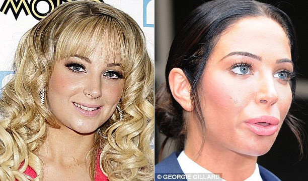 Ngôi sao Anh quốc Tulisa khiến mọi người sửng sốt khi xuất hiện trong phiên tòa mới đây với đôi môi sưng phồng, khác hẳn với hình ảnh cô cái thời còn là thành viên nhóm nhạc N Dubz.