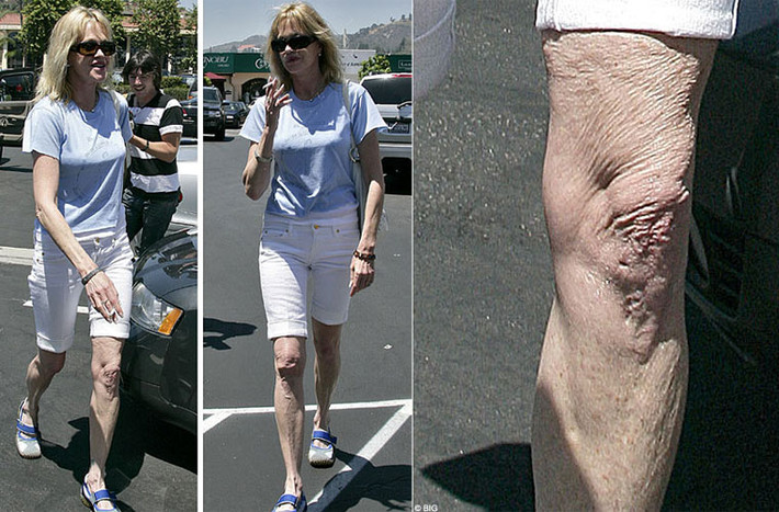 Nữ diễn viên Melanie Griffith từng có thời kỳ bị gày hẳn đi và hậu quả là đôi chân nhăn nhúm đến khó tin.