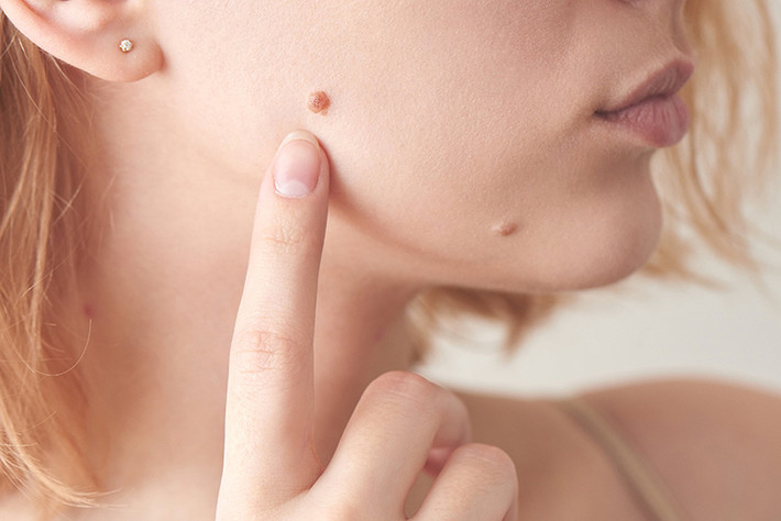 Một số nốt ruồi có thể mang lại vận rủi, trong khi những nốt ruồi khác có thể mang lại may mắn. Hãy cùng xem những nốt ruồi nào trên mặt là “nốt ruồi may mắn” nhé.