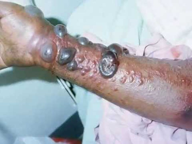 Nguyên nhân của tình trạng này là do người khỏe mạnh tiếp xúc với người bị bệnh hoặc dùng lại kim tiêm cũ đã qua sát trùng.