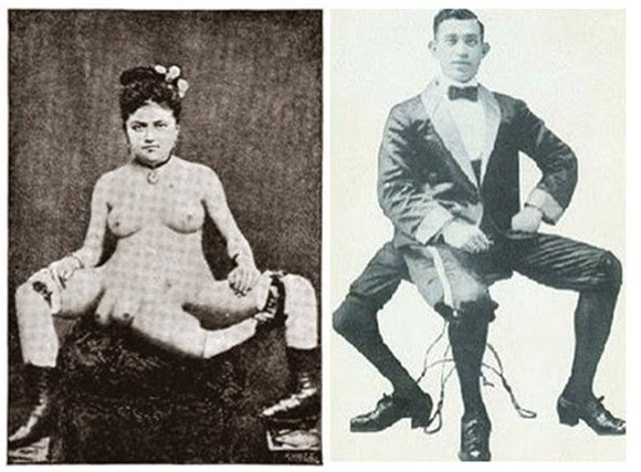 Người đàn ông có hai dương vật với cô gái có hai âm đạo: Cô Blanche Dumas sinh ra vào những năm 1800 với 3 chân, 4 vú, và 2 âm đạo. Nhiều người nghĩ rằng cuộc sống tình yêu của cô sẽ vì thế mà gặp nhiều cản trở, nhưng sự thật thì không phải như vậy. Trong thực tế, Blanche Dumas hành nghề mại dâm và được biết đến với cái tên là ả điếm Ba Chân. Một ngày nọ, cô nghe nói về Juan Baptista do Santos, người cũng đã có 3 chân, và quan trọng hơn nữa, anh ta có 2 dương vật. Sau khi suy nghĩ về mọi khả năng, họ đã gặp gỡ và đến với nhau. Theo y học, hai người này bị mắc chứng Tripedalism, khi sinh ra đã có ba chân và hai cơ quan sinh dục. Tỷ lệ mắc bệnh này cực hiếm, chỉ có 1 người mắc bệnh trong số 5,5 triệu người.