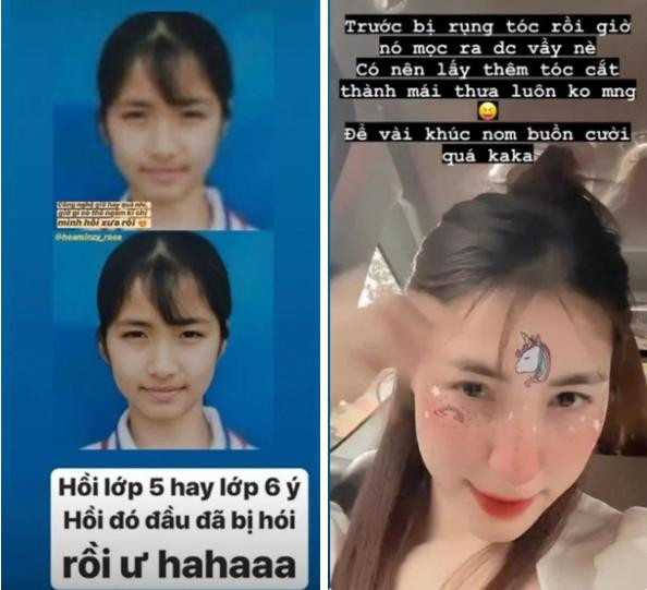 Cô nàng không giấu giếm chuyện đã bị hói từ lớp 6, và lớn lên tóc vẫn rụng không kiểm soát. Tuy nhiên tóc con ở phần mái đã mọc lên nhiều hơn