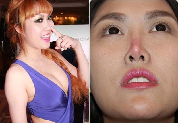 Phi Thanh Vân là ví dụ điển hình nhất của "mũi gió thổi". Trải qua vô số ca phẫu thuật thẩm mỹ, phần da đầu mũi của diễn viên ngày càng mỏng, có hiện tượng đẩy sụn và dễ hoại tử.